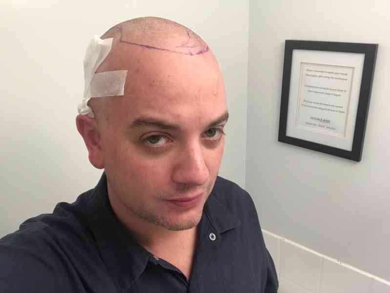 Hair Transplant, Bestie Dies, & Vancouver Island Move