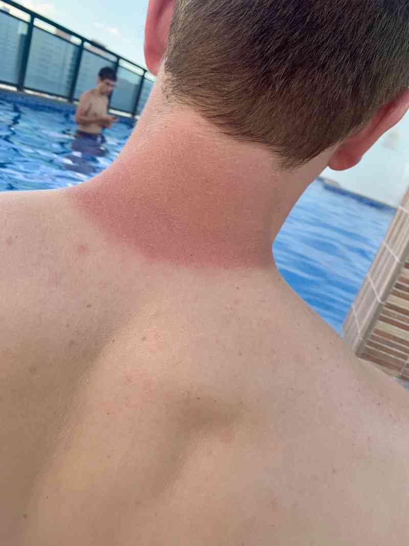 Sunburn in Manaus